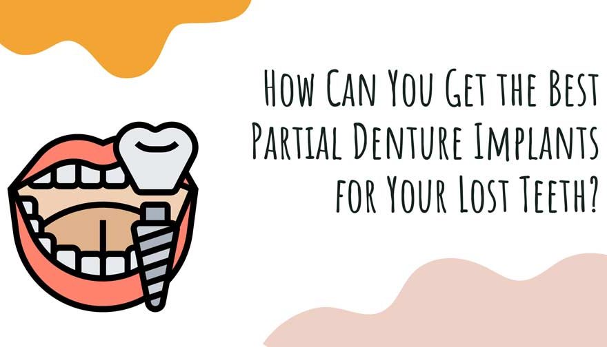 How Can You Get the Best Partial Denture Implants for Your Lost Teeth