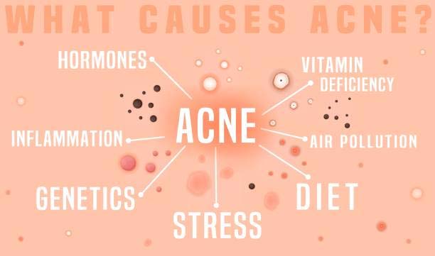 What are the types of acne, and what do they look